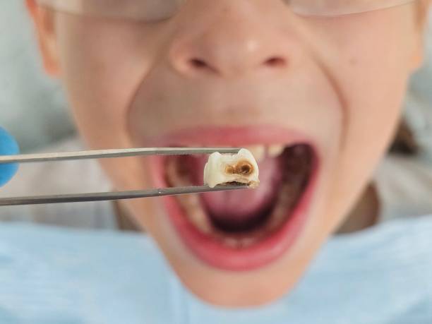 Best Emergency Tooth Extraction in Dyersburg, TN